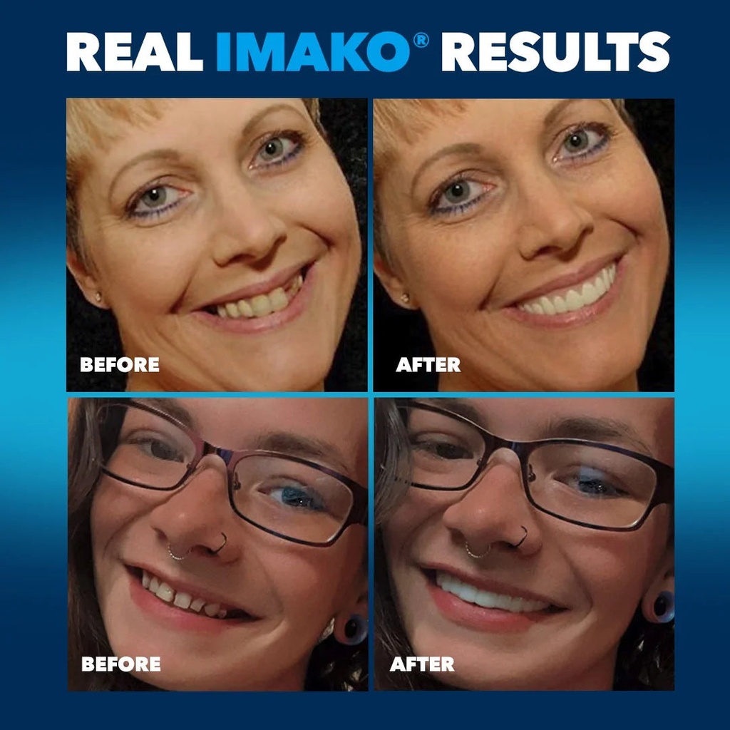 imako-premium-cosmetic-teeth-1-pack-small-bleached-white-upper-veneers-custom-fit-at-home-diy-smile-makeover-made-in-usa-03-044df384db50e000e190c6387b58be65.jpg